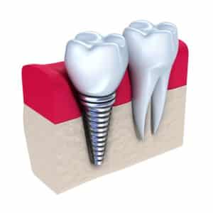 fogászati implantátum elhelyezkedése a csontozatban a mellette lévő foghoz képest
